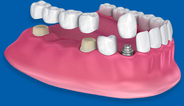 Innovative-Dental-Partners-dental-render